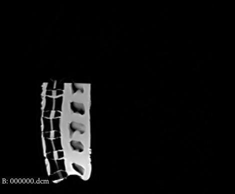 MRI slice showing vertebrae before window-leveling adjustment